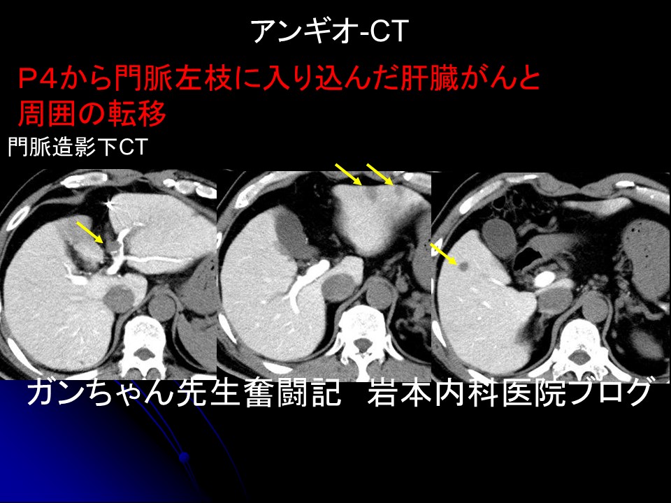 Angio CT mae masa